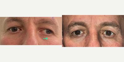 Man treated with Strabismus Surgery - Strabismus can be corrected in every age.
