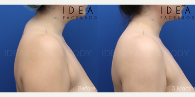 25-34 year old woman treated with Liposculpture, Smart Lipo, Tumescent Liposuction, Power-Assisted Liposuction (PAL), Laser Lipo - She came back for her 3 month post op visit with her hair up! Thats important because she never did that before. She always hid the excessive fat pad over the back of her lower neck and upper back. She loves her results from PRECISION SCULPT awake liposculpting.