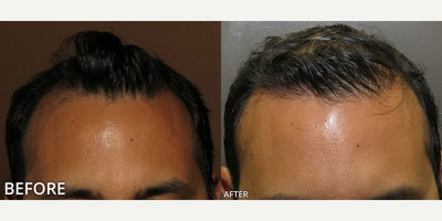 Man treated with Hair Transplant, ARTAS Robotic Hair Transplant - Man treated with Hair Transplant, ARTAS Robotic Hair Transplant