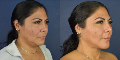 35-44 year old woman treated with Neck Lift, Buccal Fat Removal, Chin Liposuction, Micro Botox - This female patient treated with Deep Necklift, buccal fat removal and facial lipo. She has a jowl line reshaping and more facial definition.