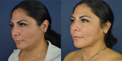35-44 year old woman treated with Neck Lift, Buccal Fat Removal, Chin Liposuction, Micro Botox - This female patient treated with Deep Necklift, buccal fat removal and facial lipo. She has a jowl line reshaping and more facial definition.