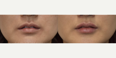 25-34 year old woman treated with Volbella, Vollure, Juvederm, Restylane Refyne, Restylane - A woman in her 30s, after the injection of Juvederm and Vollure (1cc total) into M-shaped upper and lower lips.