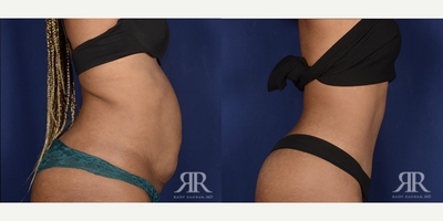 35-44 year old woman treated with Tummy Tuck - Tummy Tuck