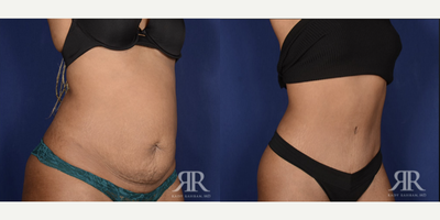 35-44 year old woman treated with Tummy Tuck - Tummy Tuck