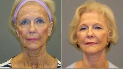 Woman treated with Neck Lift - A face lift is a surgical procedure that improves the most visible signs of aging by removing excess fat, tightening underlying muscles, and re-draping the skin of your face and neck.