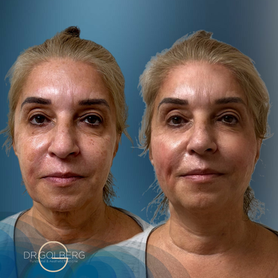 55-64 year old woman treated with Nonsurgical Facelift, Nonsurgical Neck Lift - Experience the power of Dr. Golberg's expertise and witness firsthand the transformation that the G-Lift can bring. Whether you're preparing for a special event or simply want to turn back the clock, the G-Lift offers a safe, effective, and satisfying solution. Join the countless others who have achieved radiant results and let your inner beauty shine through!