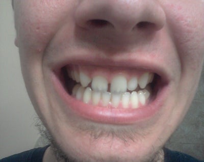 How to fix my gaps and shifted teeth? (photo) Doctor ...