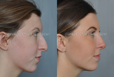 18-24 year old woman treated with Rhinoplasty - Rhinoplasty (nose surgery) is a procedure to help improve the appearance and function of your nose. Some people want a different size or shape. Others wish to repair damage caused by an injury, and some just want to breathe easier.