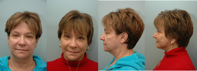 Facial Reconstructive Surgery  - 
	Facial Reconstructive Surgery
