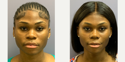 18-24 year old gender nonconforming person treated with Septoplasty, Rhinoplasty, Forehead Reduction, Brow Lift, Facial Feminiza - This is a young lady who underwent forehead reconstruction, septorhinoplasty, and mandible reduction.