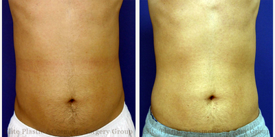 25-34 year old man treated with Exilis Elite Radio Frequency & Ultrasound on the Abdomen and flanks - Patient treated with Exilis Elite Radio Frequency + Ultrasound on Abdomen & Flanks - Before Treatment and 2 Weeks After 5th Session