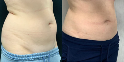 Woman treated with Liposuction - Liposuction