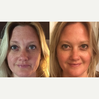 45-54 year old woman treated with Vi Peel - Vi Peel is the first medical peel that synergistically combines major acids in a pain-free formulation, launching the next generation of chemical peels. VI Peels are a safe, effective approach to achieving younger looking skin and is safe for all skin types. See significant reversal of sun damage, hyper pigmentation including melasma, acne & acne scarring, and aging skin.