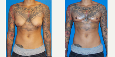 25-34 year old woman treated with FTM Chest Masculinization Surgery - Double incision FTM top surgery