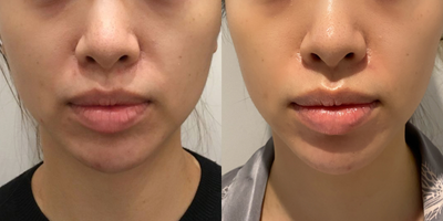 age 25-34 years old woman treated with Thermage FLX - age 25-34 years old woman treated with Thermage FLX 900 shots on lower face