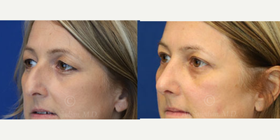 Woman treated with Eyelid Surgery - Eyelid Surgery