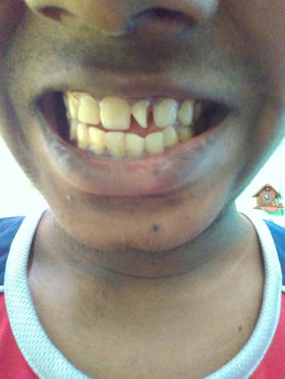 Can i fix my teeth,it looks really awkward - Braces forum