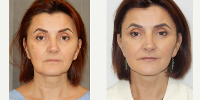 55-64 year old woman treated with Facelift, MACS Facelift - 58 year old lady requesting facial rejuvenation. Modified MACS facelift and fat grafting. Natural result at 1 year.Dr Damien Grinsell Registered medical practitioner, specialist plastic surgeon (Speciality registration in surgery - plastic surgery) AHPRA Registration: MED0001207555Any invasive procedure carries risks and individual results may vary depending on genetic factors, not limited to but including age, genetics, diet, lifestyle and existing medical conditions. Outcomes shown are only relevant to this patient and do not necessarily reflect the results other patients may experience. Before any surgery, we recommend you consult a qualified health practitioner who should discuss at length these risks, including possible outcomes and recovery/aftercare instructions specific to your procedure. If unsure, always seek a second opinion from a specialist plastic surgeon.