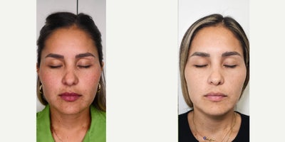 35-44 year old woman treated with Botox for TMJ - Masster Botox