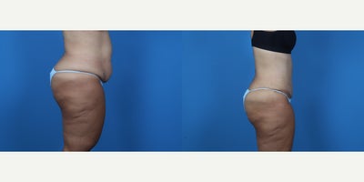 45-54 year old woman treated with Tummy Tuck - GENERAL ABDOMINOPLASTY