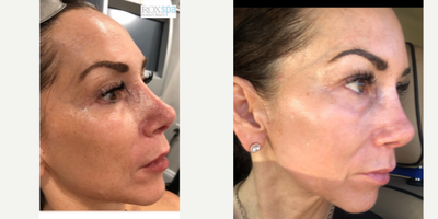 45-54 year old woman treated with Pixel Laser - Before and After Pixel with IPL After picture day 9 with mild peeling