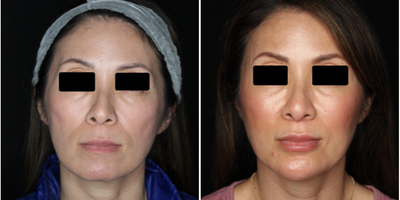 45-54 year old woman treated with Skin Rejuvenation - Full face rejuvenation with pan-facial Sculptra & HA filler ( Voluma, Restylane family, Versa and Belotero ).