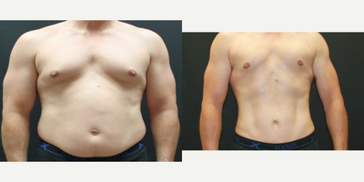 45-54 year old man treated with Male Tummy Tuck - 50 year old male Tummy Tuck