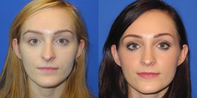 Woman treated with Rhinoplasty - Example of the power of this procedure creating a softer appearance to the face, and a very confident patient just 6 weeks after her photo.Notice the photo taken from below the nose showing the shortening of her nostrils and narrowing of the nose.