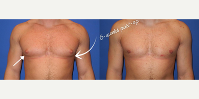 Man treated with Gynecomastia Surgery - Before and after Gynecomastia:Sometimes the most subtle changes are the most challenging.This young man had gynecomastia correction, or surgery for male breast tissue removal.The procedure is not just about removing breast tissue, but contouring the chest to make it look more masculine. Note how we release the breast fold (see arrows) to create a more masculine chest.These results are 6 weeks after surgery