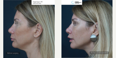 35-44 year old woman treated with Chin Liposuction - Jowl - Chin Liposuction
