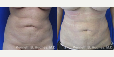 Liposuction Revision - Liposuction Revision