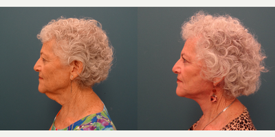 65-74 year old woman treated with Neck Lift - Patient underwent Face and Neck Lift.