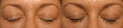 LATISSE - Patient had light colored, short lashes. With Latisse, lashes became long, darker and much fuller.