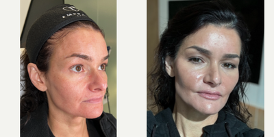 FILLER 'N THREADS COMBO - Our patient works in the industry so she would like to look her absolute best. She has noticed some signs of aging on her face, such as loss of volume in her mid face and prominent nasolabial folds. To correct this, we will be sculpting her face with filler as well as using PDO max threads- to give her a complete facial rejuvenation. We were able to  and sculpt her mid face leaving her cheeks contoured. We also gave her lips some natural looking plumpness, her chin that desired heart shaped look, and we didn't forget about defining her jaw for a snatched neck. All in all she cannot believe how amazing she looks and is in love with her results!WANT SOME FACIAL SCULPTING OR FACIAL THREADS? WHY NOT BOTH FOR THIS KILLER COMBO: