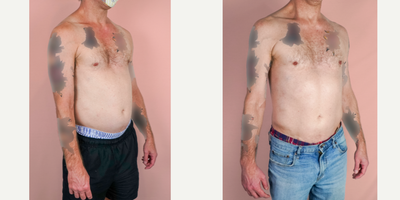 45-54 year old man treated with Vaser Liposuction - This patient wanted to remove excess fat from his abdomen and requested liposuction to improve his shape.