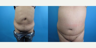 Woman treated with Tummy Tuck - Woman treated with Tummy Tuck