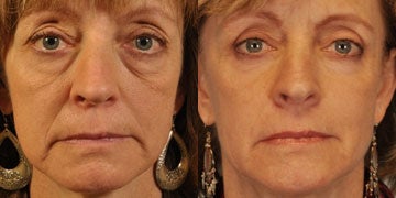 Phenol Acid Peel Worth it? Reviews, Cost, Pictures - RealSelf