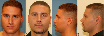 Male rhinoplasty - Revision rhinoplasty to improve droopy tip.