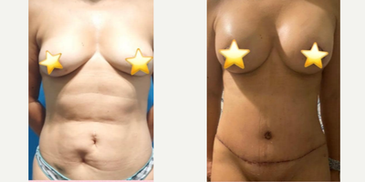 Woman treated with Breast Lift - Mommy makeover 2 weeks in a row. The origin of mommy make over includes liposuction abdominoplasty and breast augmentation and/or lifting. Although surgery is desirable because of the big change it brings, few patients are candidates because of individual characteristics of the patient, blood levels, calculated surgical times, among other things.