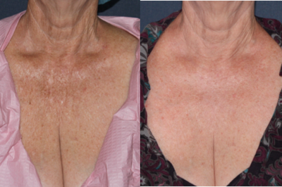 Fraxel Repair on Chest - 
	Female patient has Fraxel Repair treatment to minimize the appearance of sun spots.
