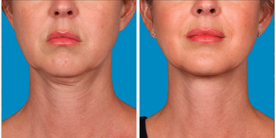 45-54 year old woman treated with Kybella for corruption of sub mental fullness /double chin - 45-54 year old woman treated with Kybella for corruption of sub mental fullness /double chin