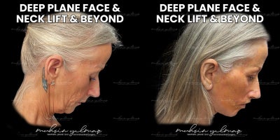 55-64 year old woman treated with Deep Plane Facelift, Deep Neck Lift, Eyelid Surgery, Lip Lift, Facial Fat Transfer - This 63-year-old patient underwent a comprehensive facial rejuvenation including Deep Plane Facelift, Deep Neck Lift, Temporal Lift, Upper Eyelid Surgery, Cantopexy, Lip Lift, Corner Lift, Fat Grafting, and CO2 Laser.At just a few weeks post-op, she already shows a refreshed, lifted, and smoother appearance. The eyes are brighter, the mid and lower face more defined, and skin texture visibly improvedachieving a naturally youthful and elegant look.