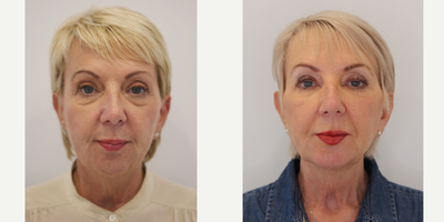 55-64 year old woman treated with Nonsurgical Facelift, Carboxytherapy, Dermal Fillers - This beautiful patient tough that surgery is the only option to help her to reduce eye bags. I have formulated a complex treatment plan that was involve use of combination therapies : non surgical face lift with Dermal fillers , following carboxy therapy for eye bags and tear trough treatment .Maintanace program :Anti -wrinkle treatment every 4 month Dermal fillers annual 5-7 mls 5 years later initial treatment with righ maintanance regime she looks and feels fabulous