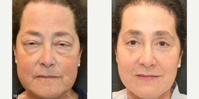 45-54 year old woman treated with Facelift, Neck Lift, Brow Lift, Eyelid Surgery, Ptosis Surgery - Face and Neck Lift, Brow Lift, Quad Blepharoplasty, Ptosis Repair