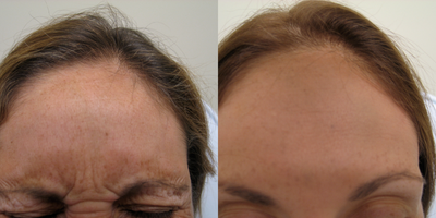 45-54 year old woman treated with Glycolic Peel - Dysport treatment