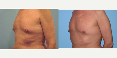 55-64 year old man treated with CoolSculpting - CoolSculpting procedure