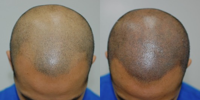 18-24 year old man treated with Hair Loss Treatment Scalp MicroPigmentation SMP - Scalp MicroPigmentation SMP