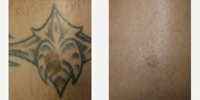 Man treated with Tattoo Removal - Tattoo RemovalThis patient was treated for the removal of his tattoo. Laser treatments were performed until the tattoo was no longer present. The laser treatments also improved the appearance of this patients birthmark.