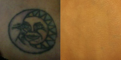 Woman treated with Tattoo Removal - Tattoo RemovalThis young lady came to Dr. Duplechain desiring the removal of her tattoo. Dr. Duplechain consulted with the patient to explain the process of treatments. Laser treatments were then performed until the desired result was achieved.