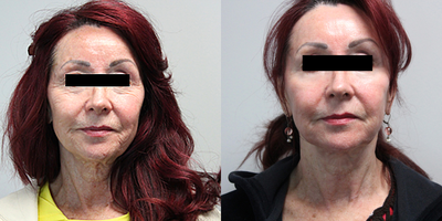 65-74 year old woman treated with Fraxel Laser - Fraxel laser treatment results after 1 treatment.